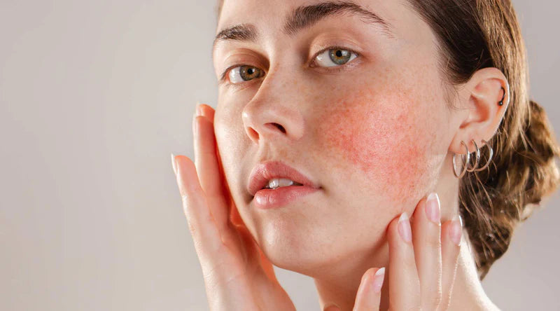 UNMASKING THE TRUTH: UNDERSTANDING ROSACEA DURING ROSACEA AWARENESS MONTH